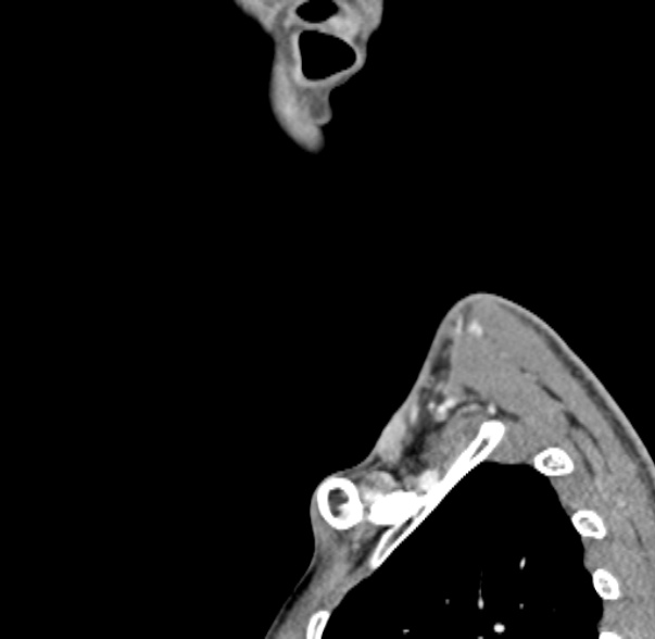 Nasopharyngeal carcinoma with skull base invasion (Radiopaedia 53415-59705 C 2).jpg