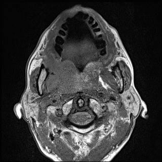 Nasopharyngeal carcinoma with skull base invasion (Radiopaedia 59258-66600 B 29).jpg