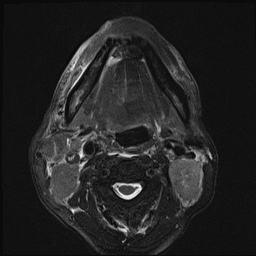 File:Nasopharyngeal carcinoma with skull base invasion (Radiopaedia 59258-66600 D 39).jpg