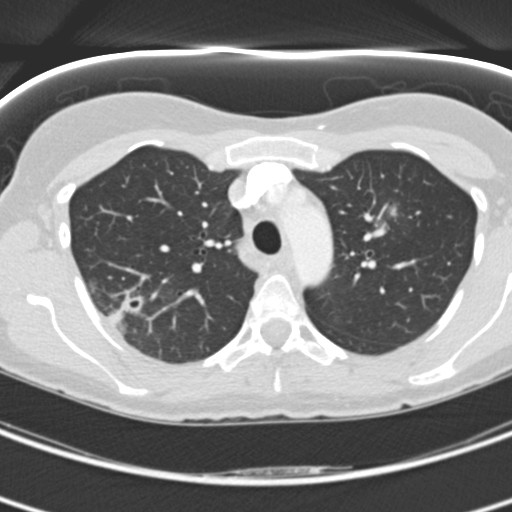 Necrobiotic pulmonary nodules - Crohn disease (Radiopaedia 20723-20631 Axial lung window 41).jpg