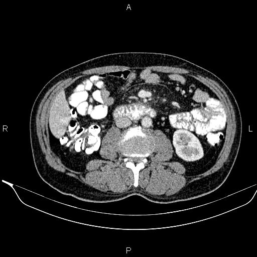 Necrotizing pancreatitis (Radiopaedia 87796-104249 A 28).jpg