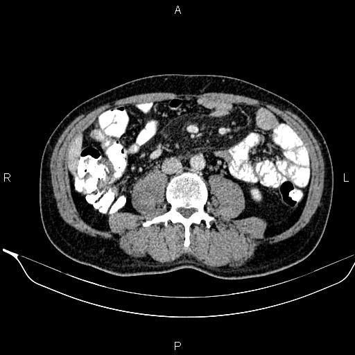 Necrotizing pancreatitis (Radiopaedia 87796-104249 A 31).jpg