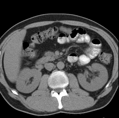 File:Necrotizing pancreatitis with acute necrotic collection (Radiopaedia 14470-14417 Axial non-contrast 19).jpg