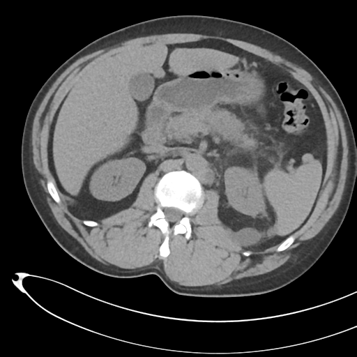 File:Necrotizing pancreatitis with acute necrotic collections (Radiopaedia 38829-41012 Axial non-contrast 31).png