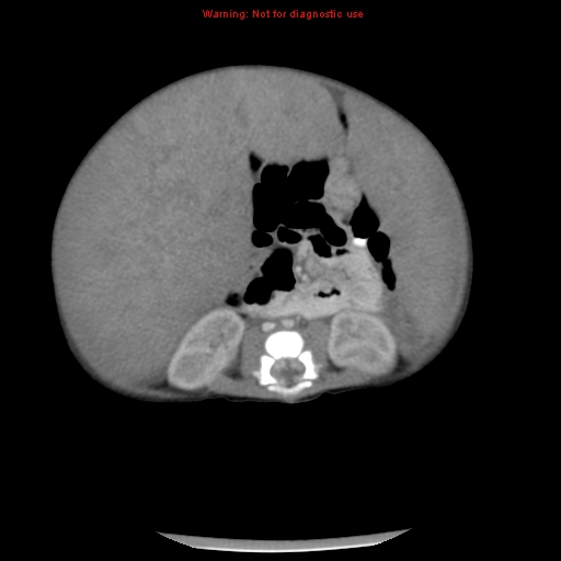 File:Neonatal neuroblastoma (Radiopaedia 9564-10223 A 32).jpg