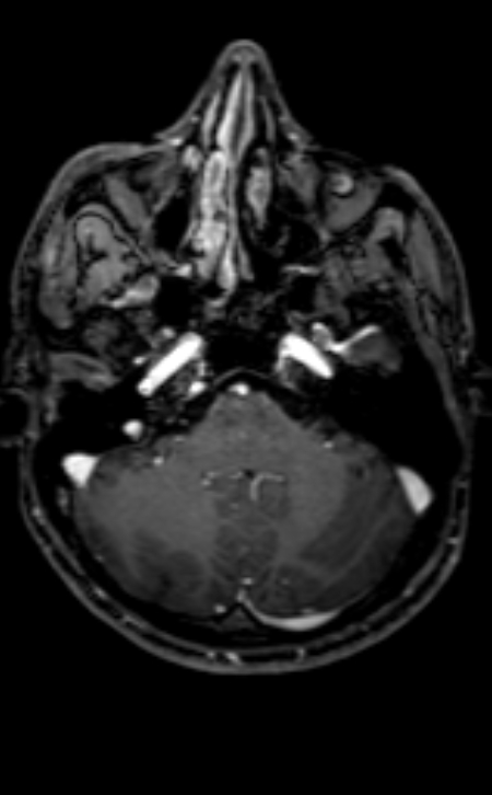 Neuro-Behçet disease (Radiopaedia 90112-107294 Axial T1 C+ 173).jpg