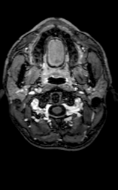 Neuro-Behçet disease (Radiopaedia 90112-107294 Axial T1 C+ 207).jpg