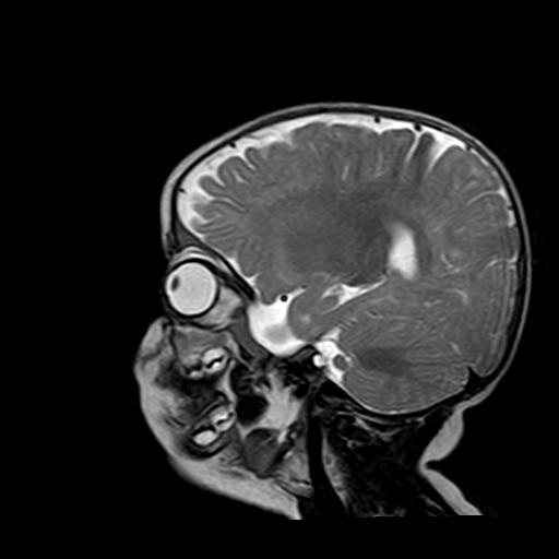 File:Neurofibromatosis type 1 (Radiopaedia 30089-30671 Sagittal T2 4).jpg