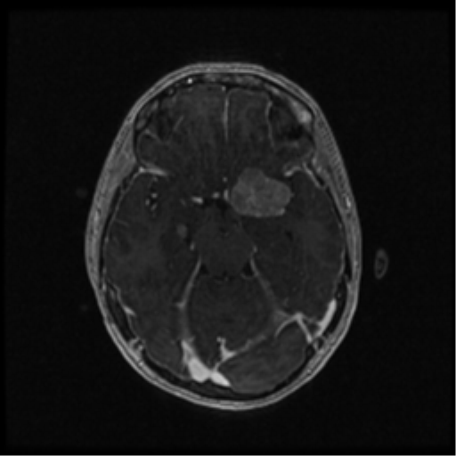 Neurofibromatosis type 2 (Radiopaedia 45229-49244 Axial T1 C+ 53).png