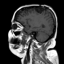 File:Neurofibromatosis type 2 (Radiopaedia 8713-9518 Sagittal T1 6).jpg