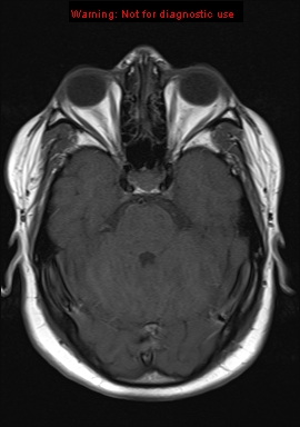 File:Neuroglial cyst (Radiopaedia 10713-11184 Axial T1 16).jpg