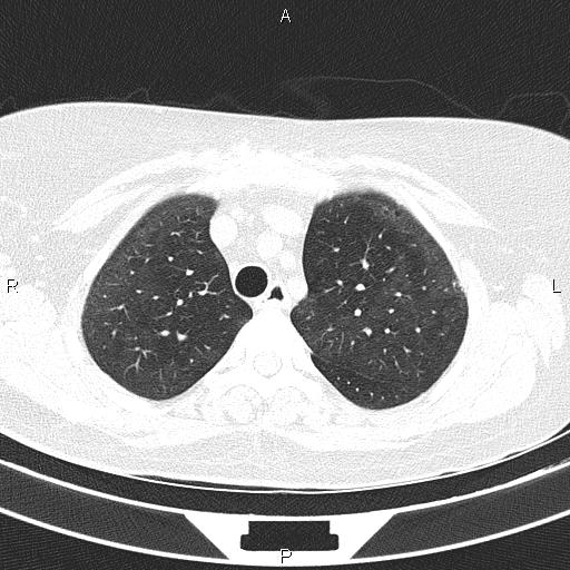 Non-specific interstitial pneumonia (Radiopaedia 83185-97567 Axial lung window 19).jpg