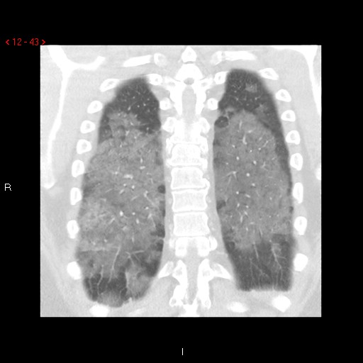 File:Non-specific interstitial pneumonitis (Radiopaedia 27044-27222 Coronal lung window 43).jpg