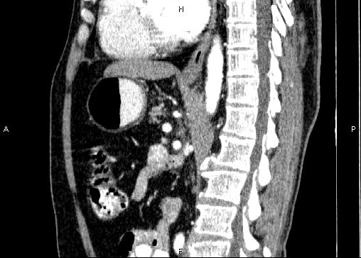 Non-syndromic pancreatic endocrine tumor (Radiopaedia 86958-103178 E 54).jpg