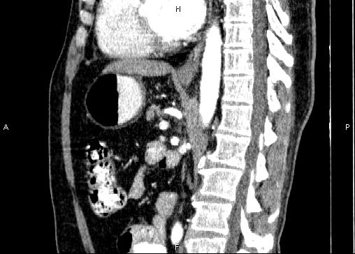 Non-syndromic pancreatic endocrine tumor (Radiopaedia 86958-103178 E 55).jpg
