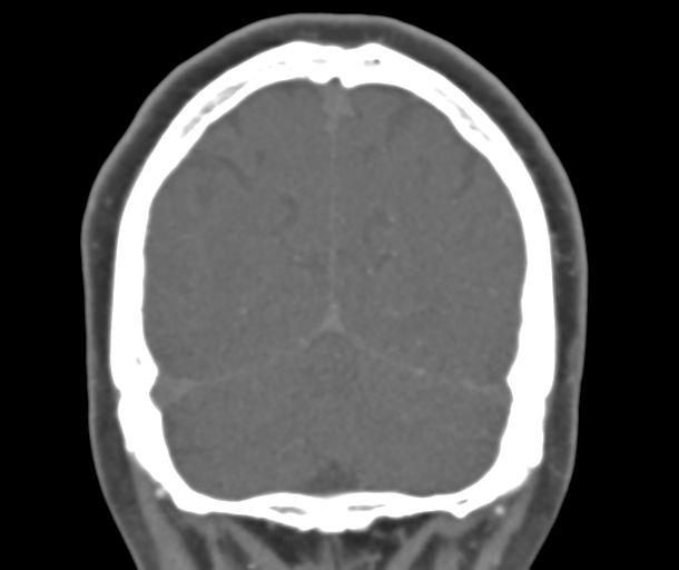 File:Normal CTA head (Radiopaedia 40801-43464 B 77).png