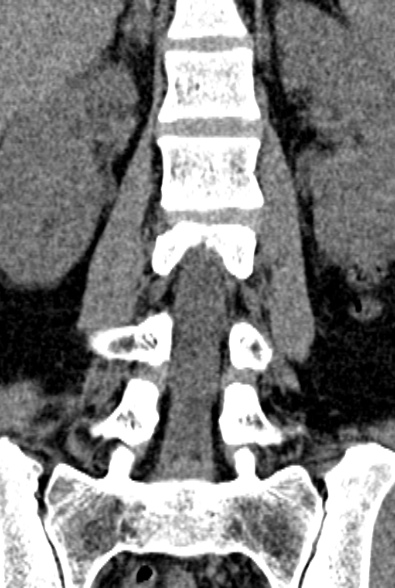 Normal CT lumbar spine (Radiopaedia 53981-60118 F 45).jpg