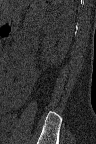 File:Normal CT lumbar spine (Radiopaedia 53981-60118 Sagittal bone window 97).jpg