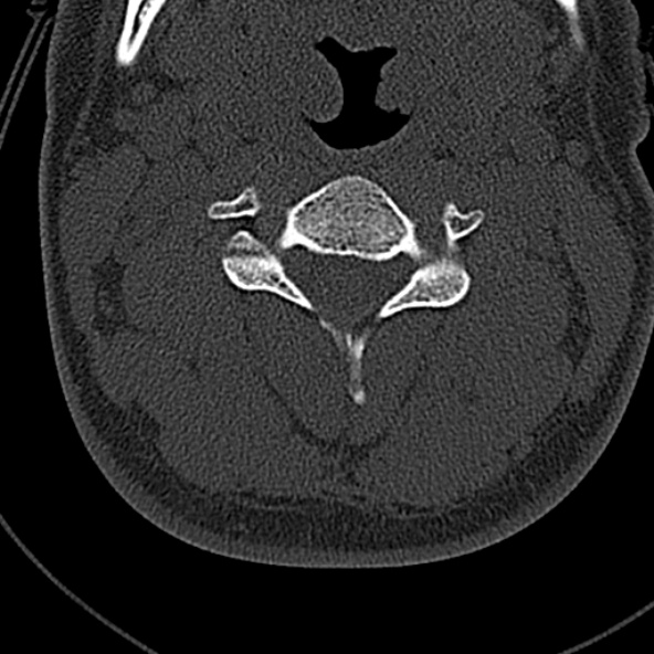 File:Normal CT of the cervical spine (Radiopaedia 53322-59305 Axial bone window 113).jpg