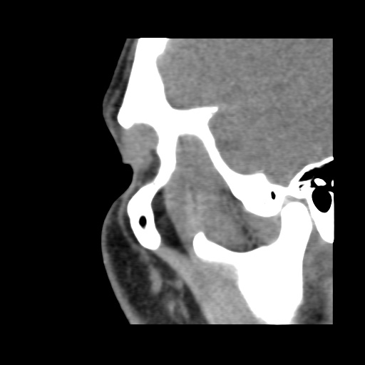 Normal CT paranasal sinuses (Radiopaedia 42286-45390 F 32).jpg