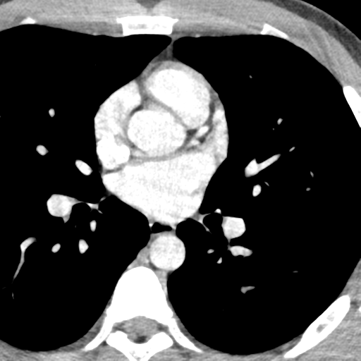 File:Normal CT pulmonary veins (pre RF ablation) (Radiopaedia 41748-44702 A 129).png
