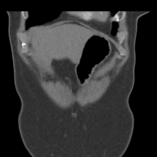 File:Normal CT renal artery angiogram (Radiopaedia 38727-40889 B 12).png