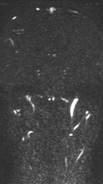Normal MRI brain with MRV- teenager (Radiopaedia 49425-54553 Coronal MRV 141).jpg
