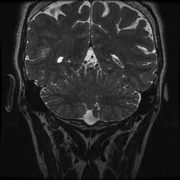 Normal MRI petrous (Radiopaedia 91317-108949 Coronal T2 109).jpg