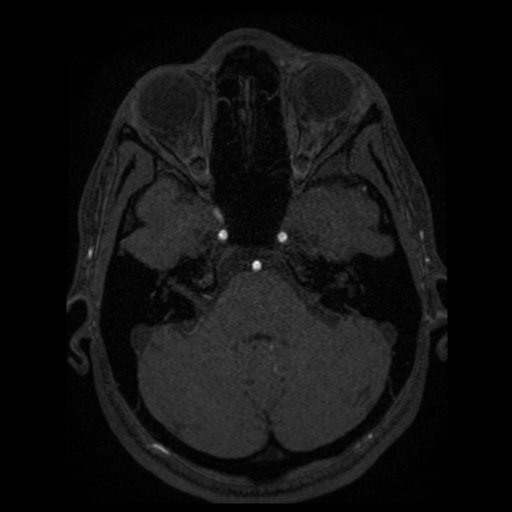 Normal brain MRA (Radiopaedia 41046-43793 Axial MRA 85).png