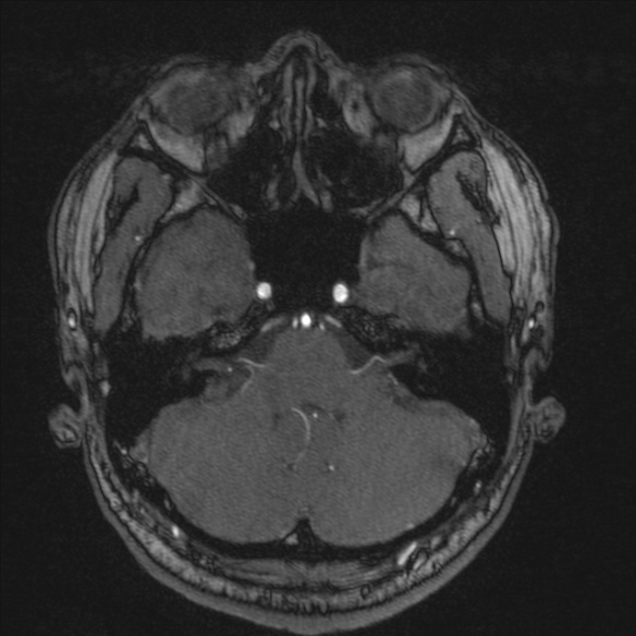 Normal brain MRI including MRA (Radiopaedia 48748-53763 Axial MRA 43).jpg