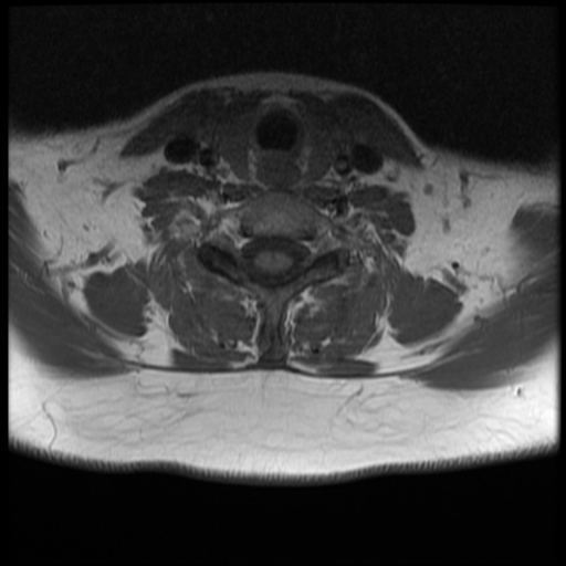 File:Normal cervical and thoracic spine MRI (Radiopaedia 35630-37156 Axial T1 11).png