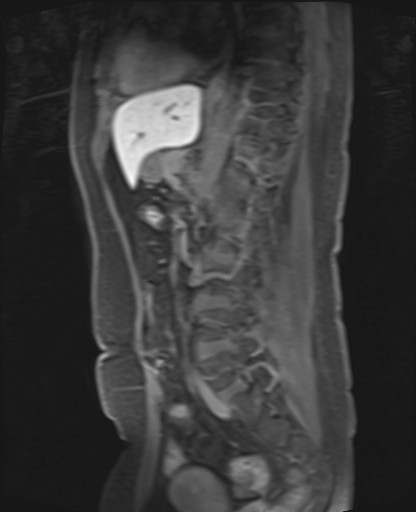 File:Normal hepatobiliary phase liver MRI (Radiopaedia 58968-66230 C 46).jpg