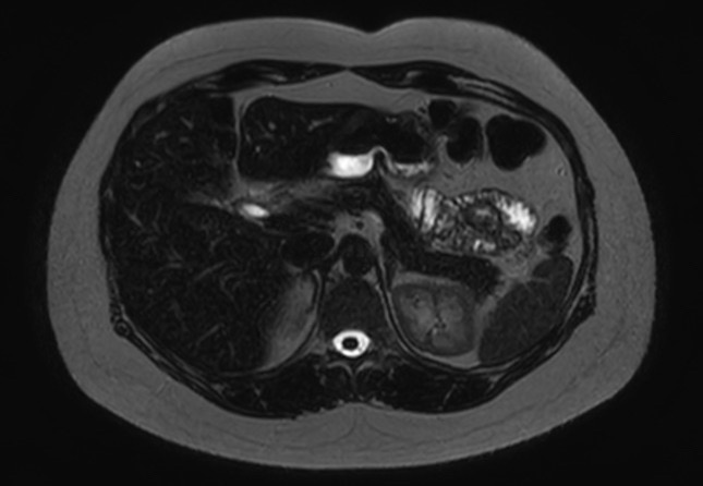 File:Normal liver MRI with Gadolinium (Radiopaedia 58913-66163 E 20).jpg