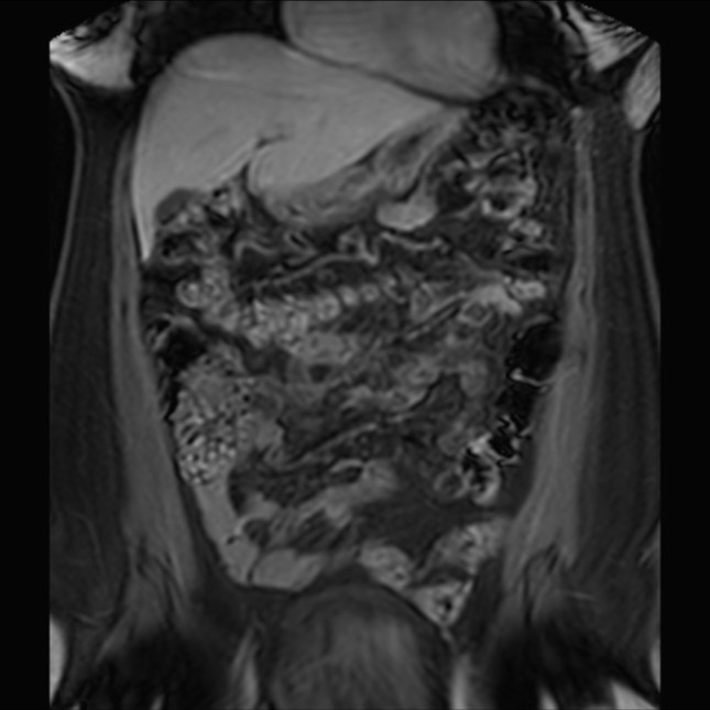Normal liver MRI with Gadolinium (Radiopaedia 58913-66163 P 30).jpg