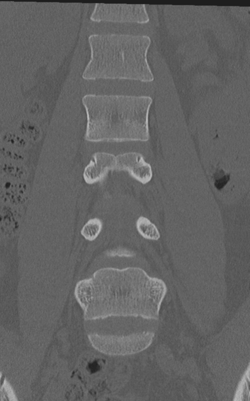 Normal lumbar spine CT (Radiopaedia 46533-50986 Coronal bone window 33).png
