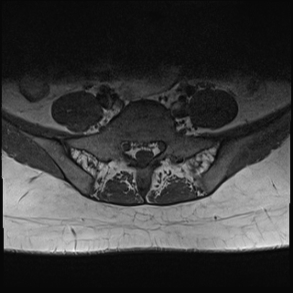 File:Normal lumbar spine MRI- 3 T (Radiopaedia 53280-59250 Axial 30).jpg