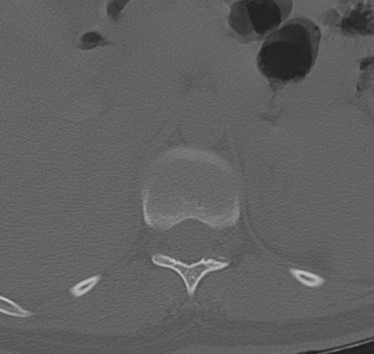 File:Normal lumbosacral CT (Radiopaedia 37923-39867 Axial bone window 15).png