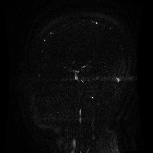 Normal noncontrast MR venography (Radiopaedia 87578-103957 A 66).jpg