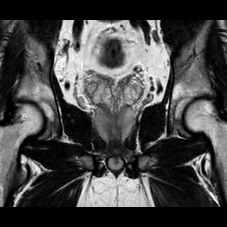 File:Normal prostate (MRI) (Radiopaedia 29986-30535 Coronal T2 12).jpg