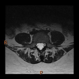File:Normal spine MRI (Radiopaedia 77323-89408 Axial T2 18).jpg