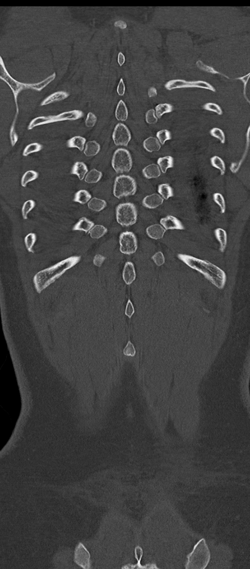 Normal thoracolumbar spine (Radiopaedia 43822-47309 Coronal bone window 80).png