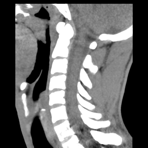 File:Normal trauma cervical spine (Radiopaedia 41017-43760 B 15).png