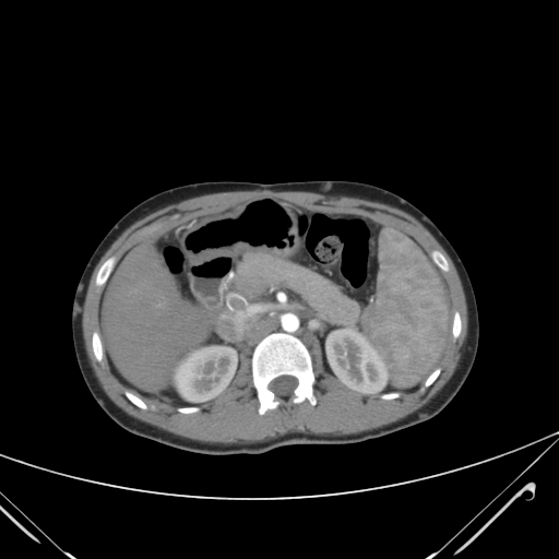 File:Nutmeg liver- Budd-Chiari syndrome (Radiopaedia 46234-50635 A 28).png