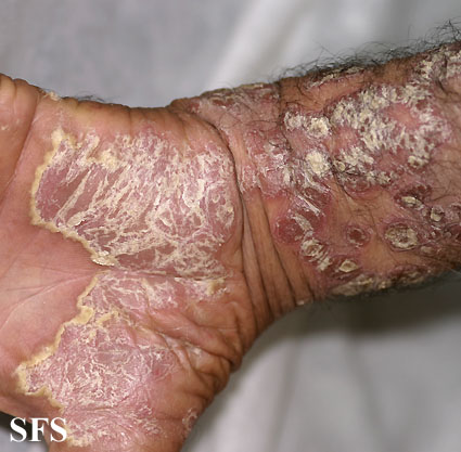 File:Psoriasis (Dermatology Atlas 33).jpg
