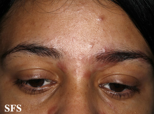 File:Sarcoidosis (Dermatology Atlas 23).jpg