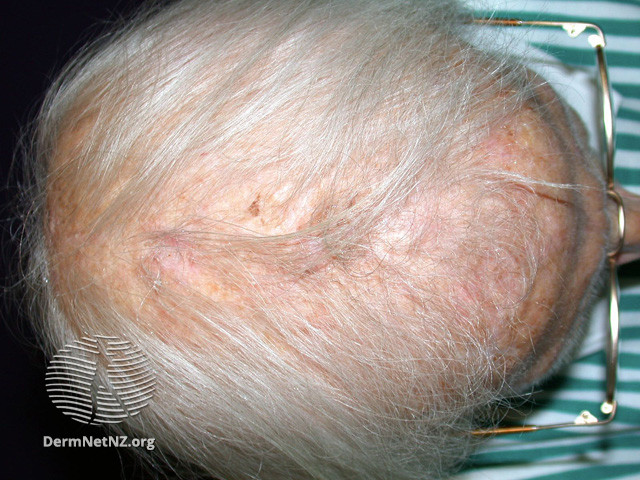 File:Severe female pattern balding (DermNet NZ hair-nails-sweat-female-balding1).jpg