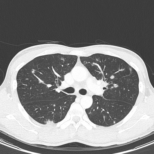AIDS-related Kaposi sarcoma (Radiopaedia 85247-100811 Axial lung window 63).jpg