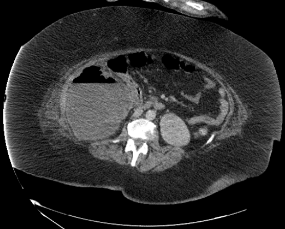 File:Abdominal abscess - pre and post percutaneous drainage (Radiopaedia 60209-67816 Axial 9).png