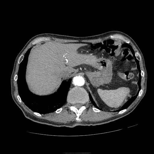 Abdominal aortic aneurysm (Radiopaedia 13341-13340 Axial C+ arterial phase 30).jpg