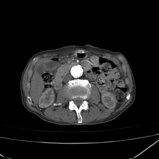 Abdominal aortic aneurysm (Radiopaedia 23703-23856 Axial C+ arterial phase 35).jpg